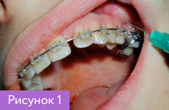 Установка ортодонтических имплантов - 1