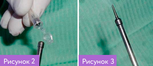 Установка ортодонтических имплантов - 2