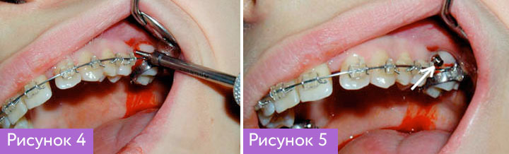 Установка ортодонтических имплантов - 3