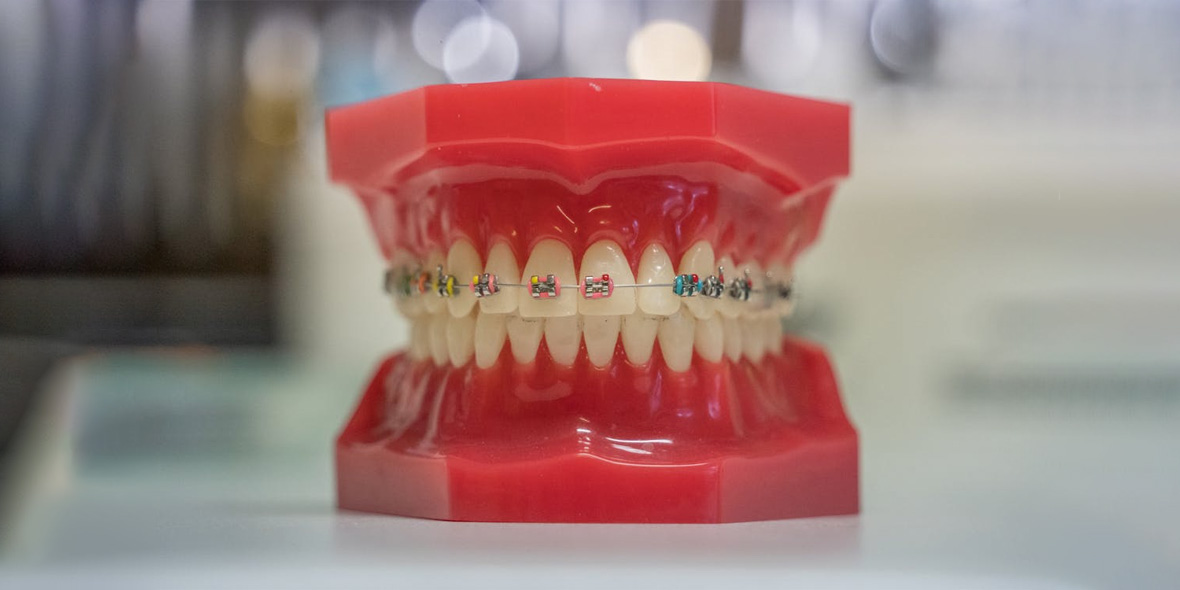 Элайнеры и брекеты: сравнение, плюсы и минусы