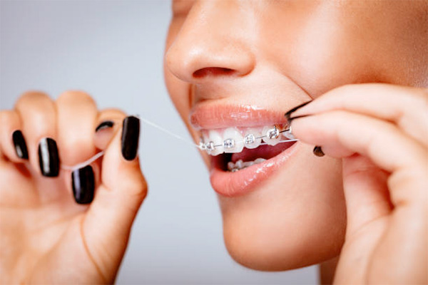 Как ухаживать за ретейнерами для зубов