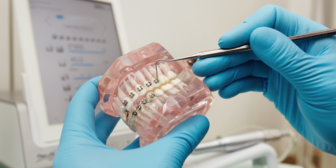 Металлические, сапфировые, керамические брекеты: что выбрать?