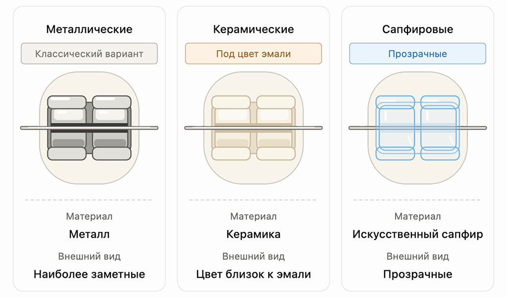 Виды брекетов