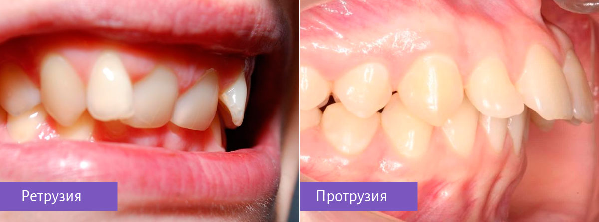 Ретрузия и протрузия зубов