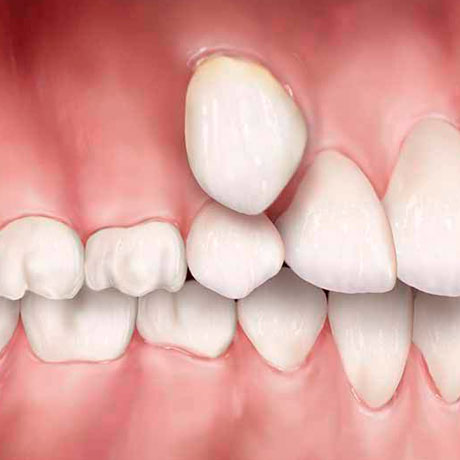 Аномалии положения зубов 