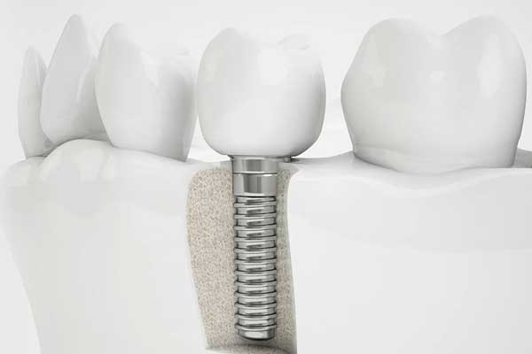 Исправление прикуса при подготовке зубов к имплантации