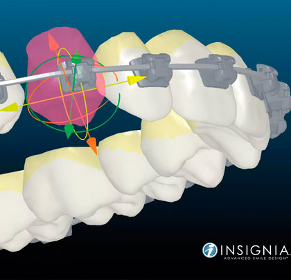 Цифровая ортодонтия Insignia