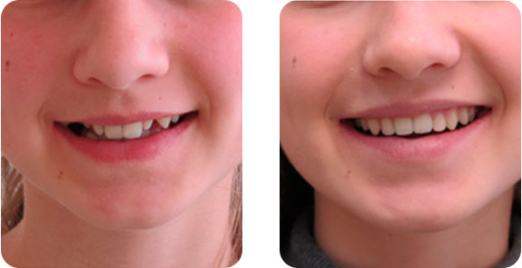 Устранение транспозиции и микродентии зубов брекет-системой и эстетическими реставрациями