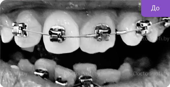 Ортодонтическое лечение самолигирующими брекетами