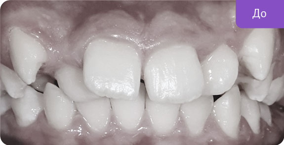 Ортодонтическое лечение брекет-системой Damon