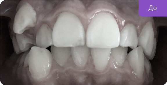 Ортодонтическое лечение скученного положения передних зубов