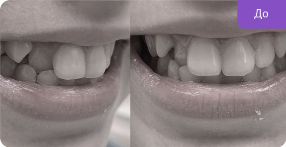 Ортодонтическое лечение с использованием съёмной пластинки на верхнюю челюсть