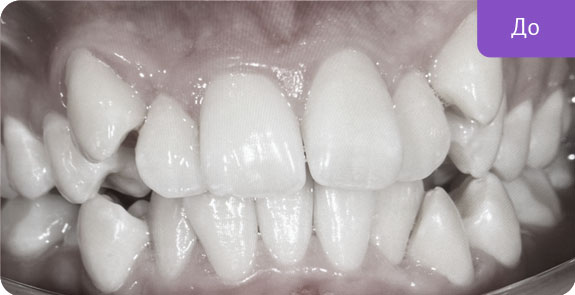 Исправление неправильного положения зубов