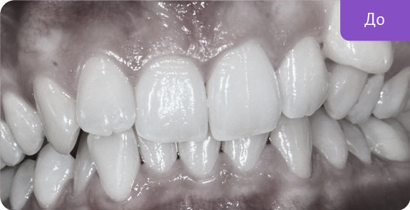 Исправление неправильного положения зубов