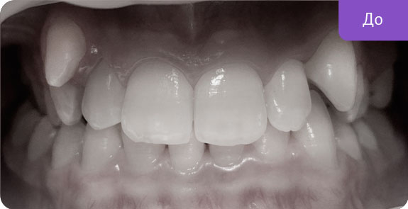   Ортодонтическое лечение брекет-системой Даймон Кью